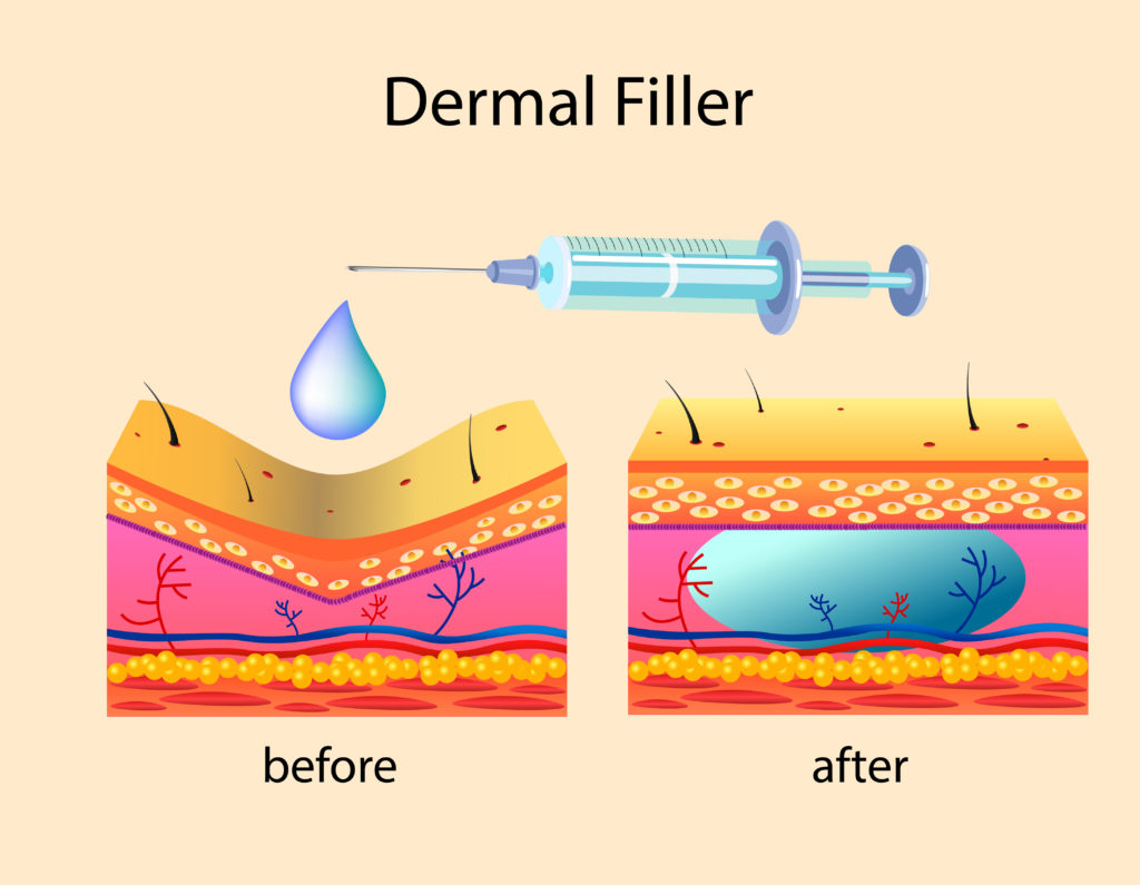 Dermal Filler | Savvy Med Spa